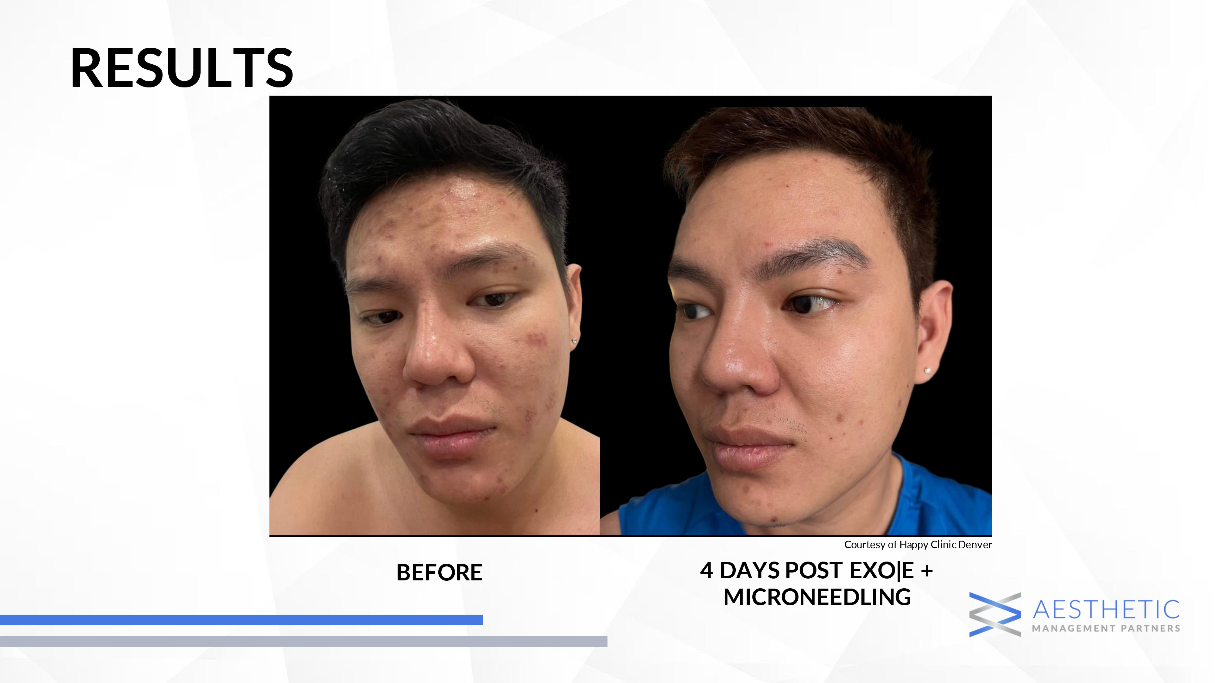 Microneedling