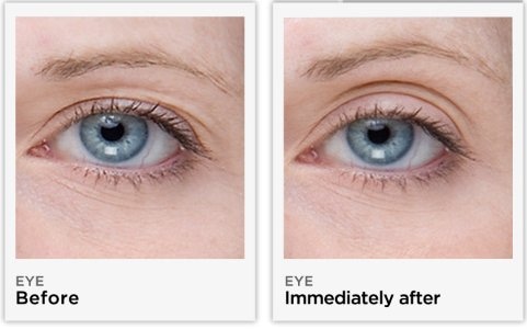 Eyelid Lift Treatment