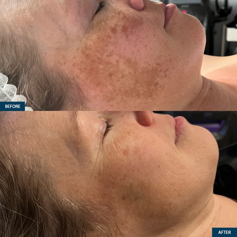 Microneedling