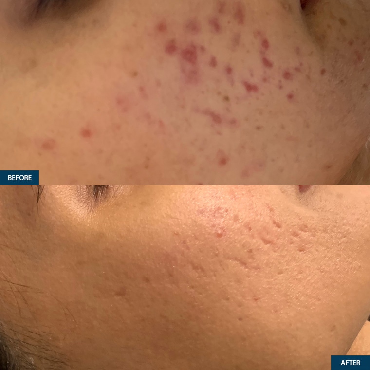 Microneedling