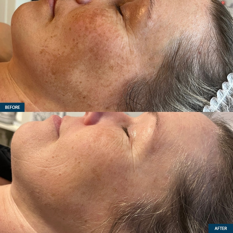 Microneedling